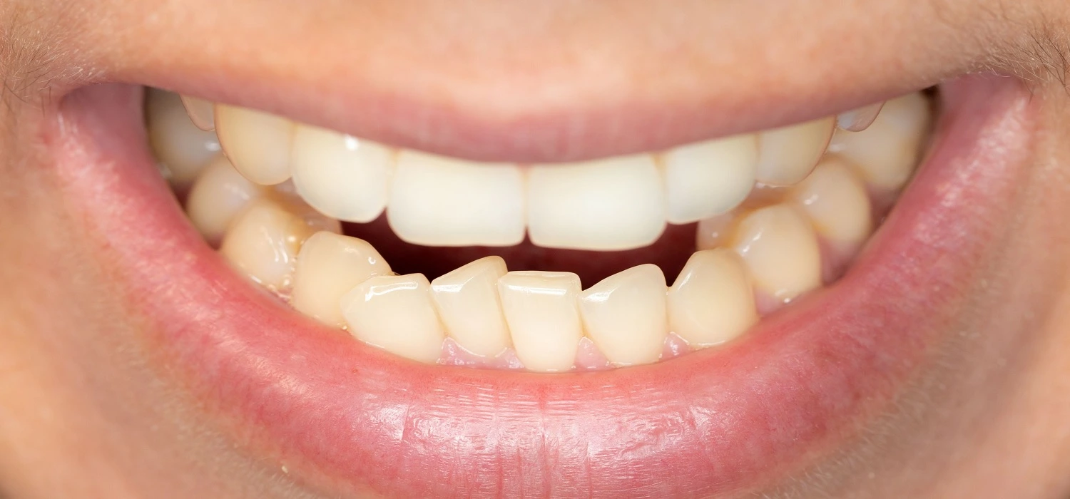 Luxación Dental: 5 Tipos Definitivos de Luxación 