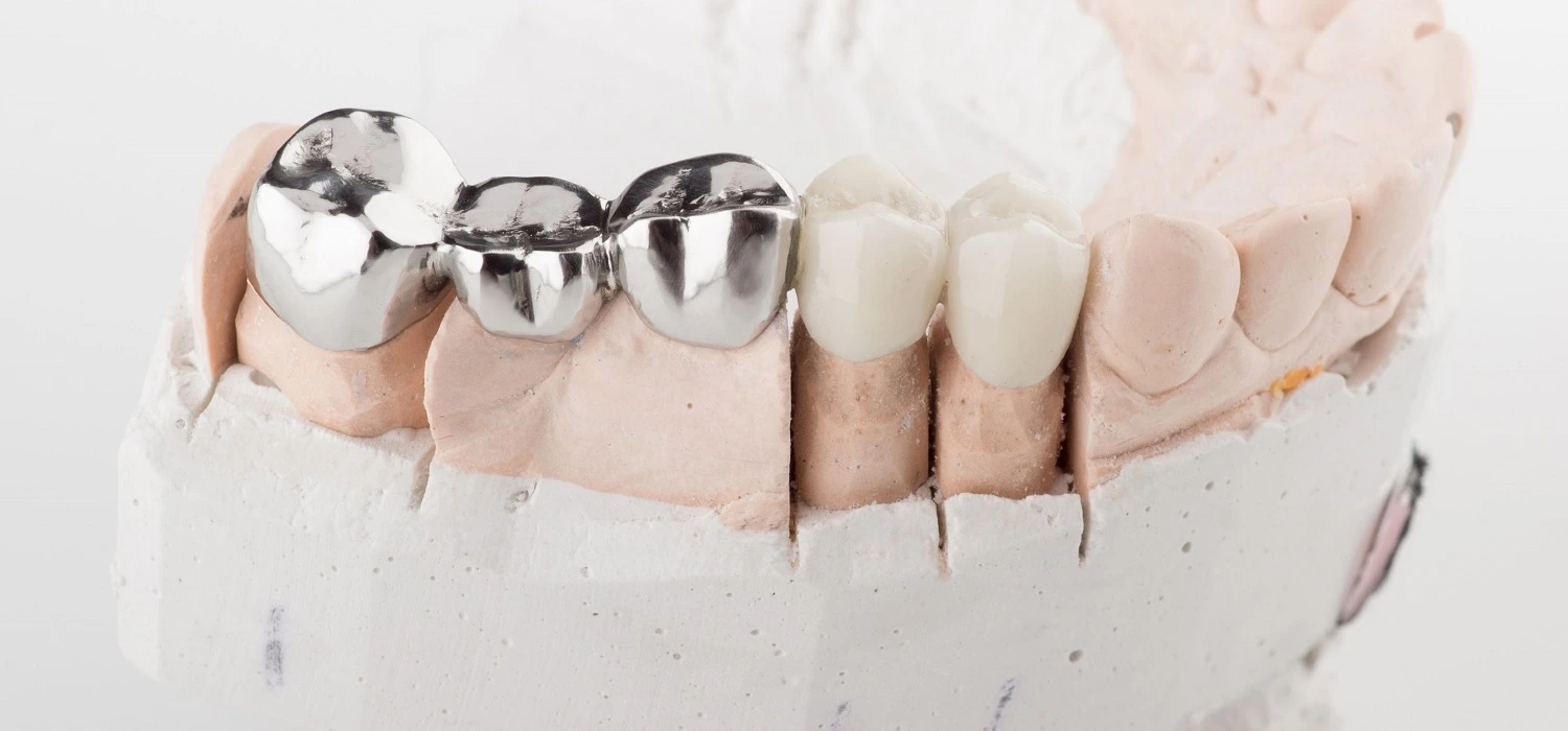 metallic-dentures