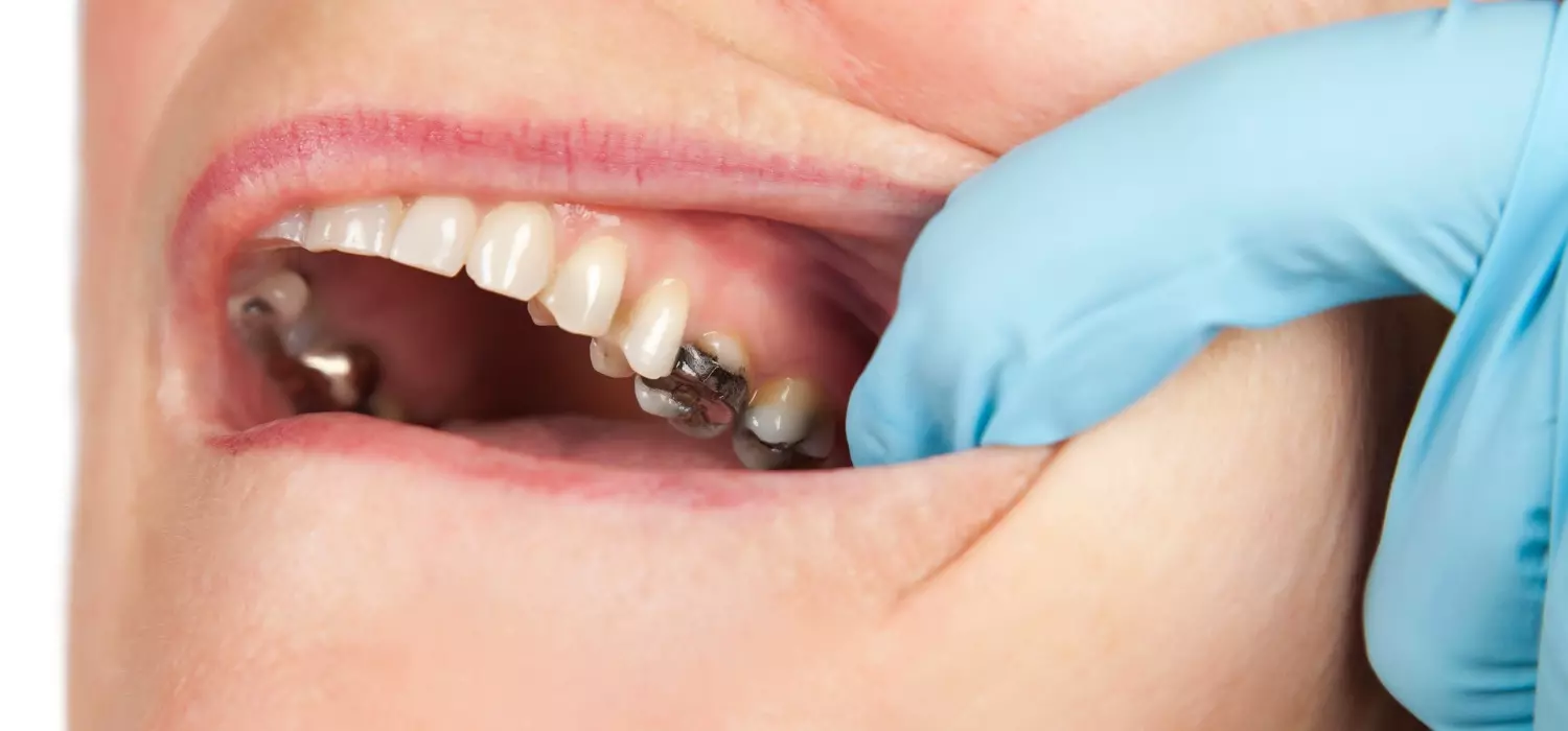 dental-cavities
