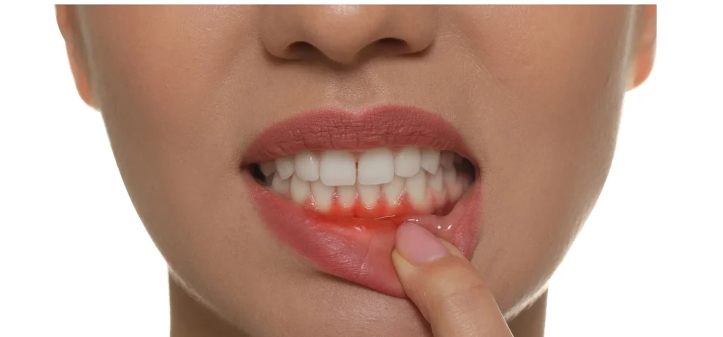 swollen-gums