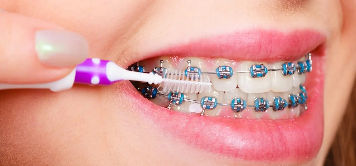 cleaning-dental-braces