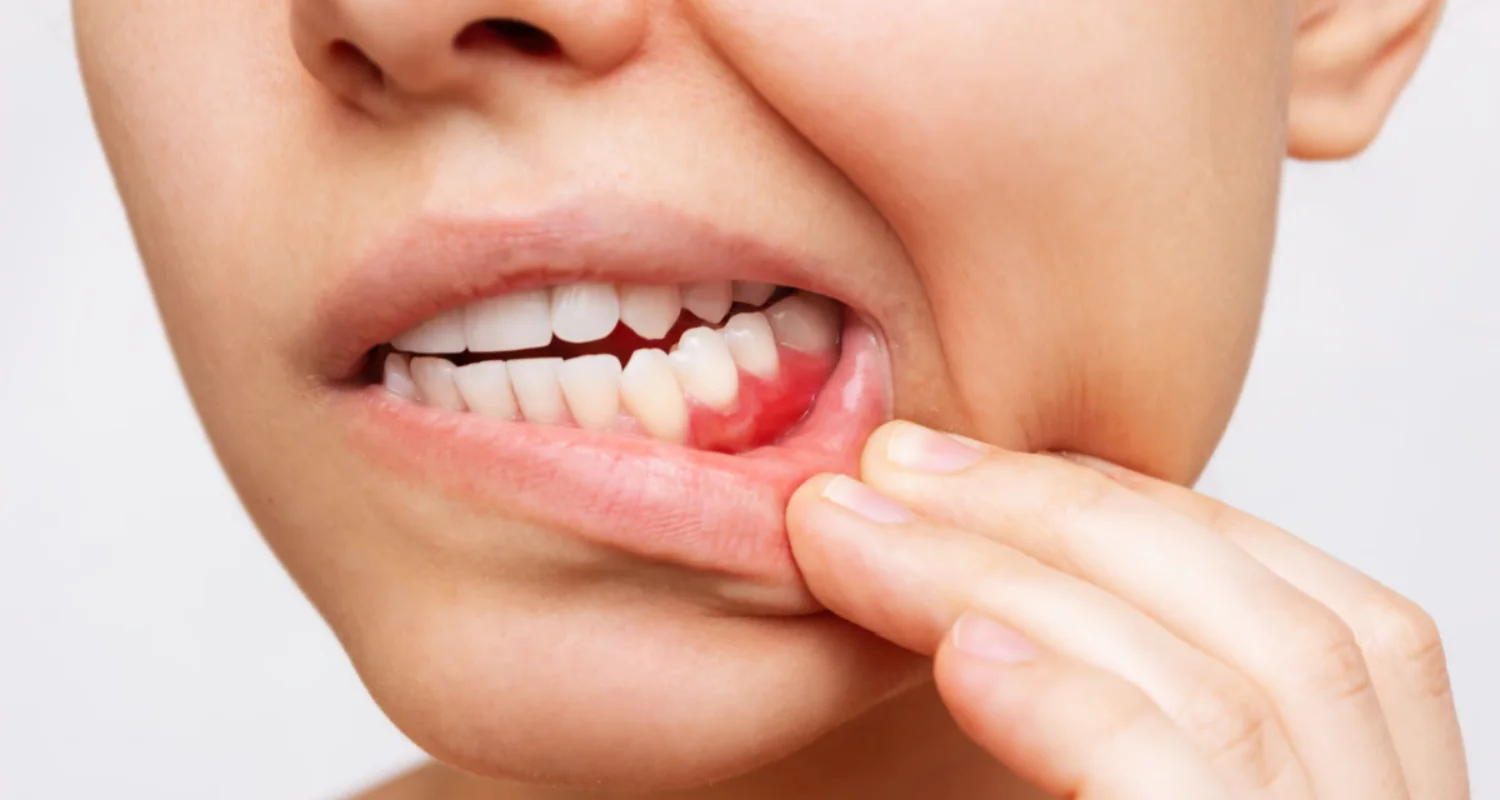 How to Drain a Tooth Abscess at Home With 7 Useful Remedies