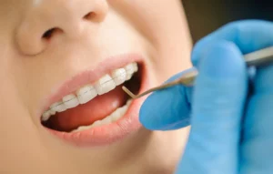 Why Are Cavities Caused by Braces So Common?