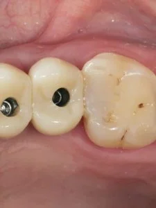 cavities-under-dental-crowns