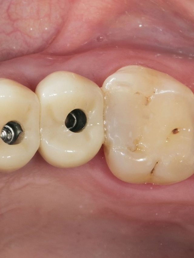 Important Signals of Cavities Under Dental Crowns
