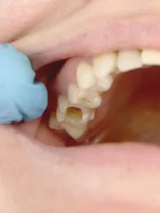 wisdom-tooth-hole-never-closed