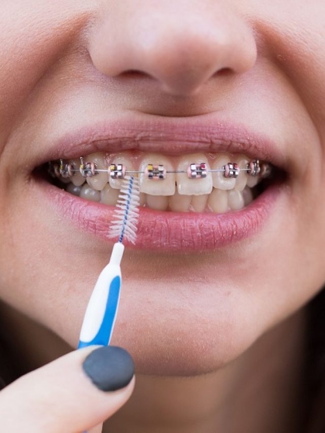 6 Effective Oral Hygiene Steps to Prevent Cavities Caused by Braces
