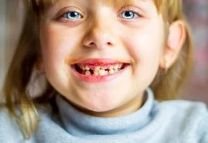 Crooked Teeth in Babies: 5 Situations Lead to Crooked Teeth