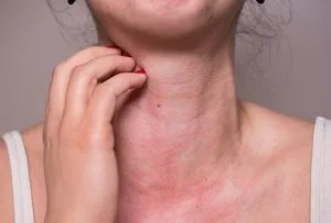 eczema