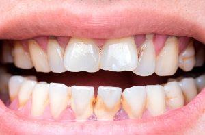 exposed-dentin