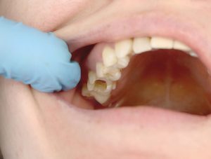 wisdom tooth hole doesn't close and el agujero de la muela del juicio no cierra