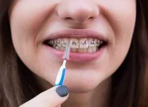 Cavities Caused by Braces: 6 Useful Oral Hygiene Steps