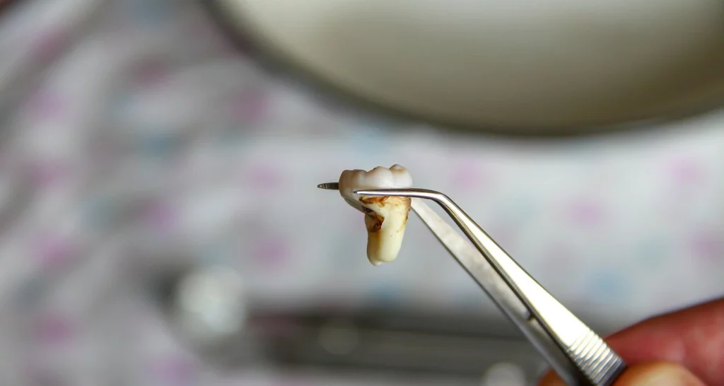 avulsed tooth