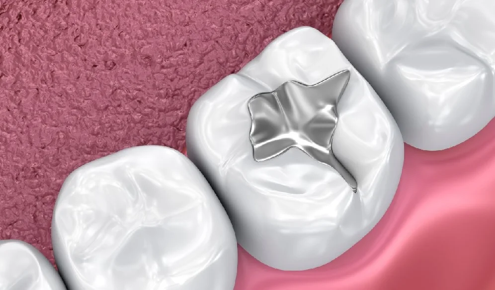 Restauraciones dentales en resina compuesta