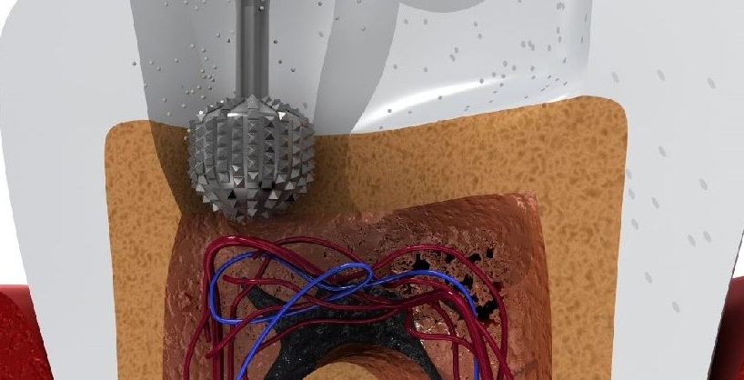 tooth undergoing treatment