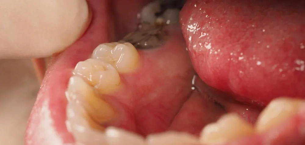 decayed tooth in need of endodontic surgery