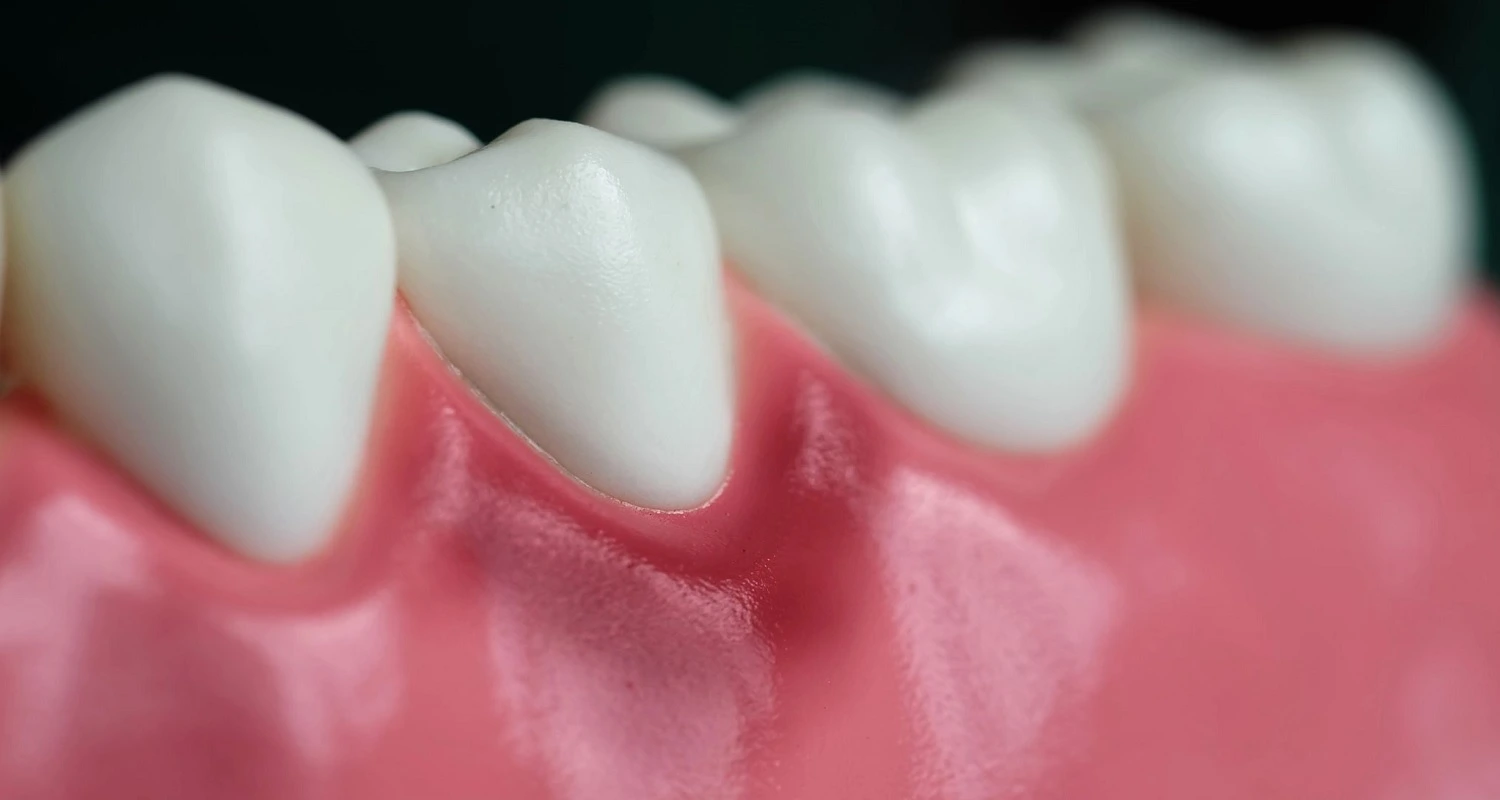 What is Gum Contouring 6 Remarkable Benefits For Your Smile