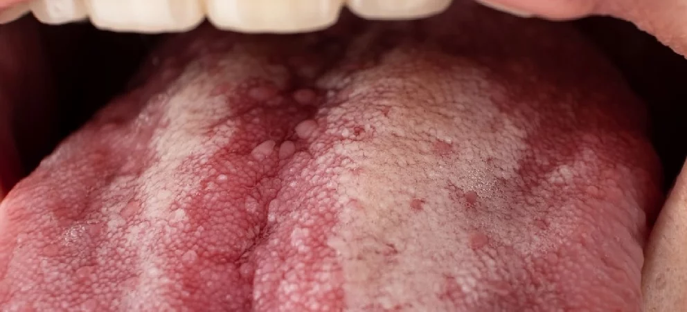 close up look of a tongue with oral cancer