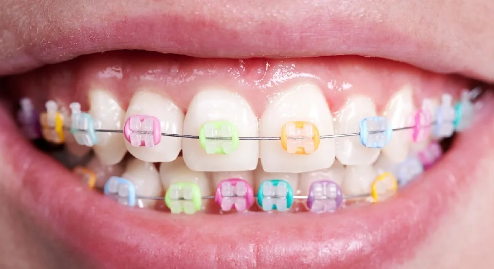 colorful braces