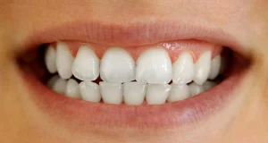 Teeth Contouring: 6 Benefits to Enhance Your Perfect Smile