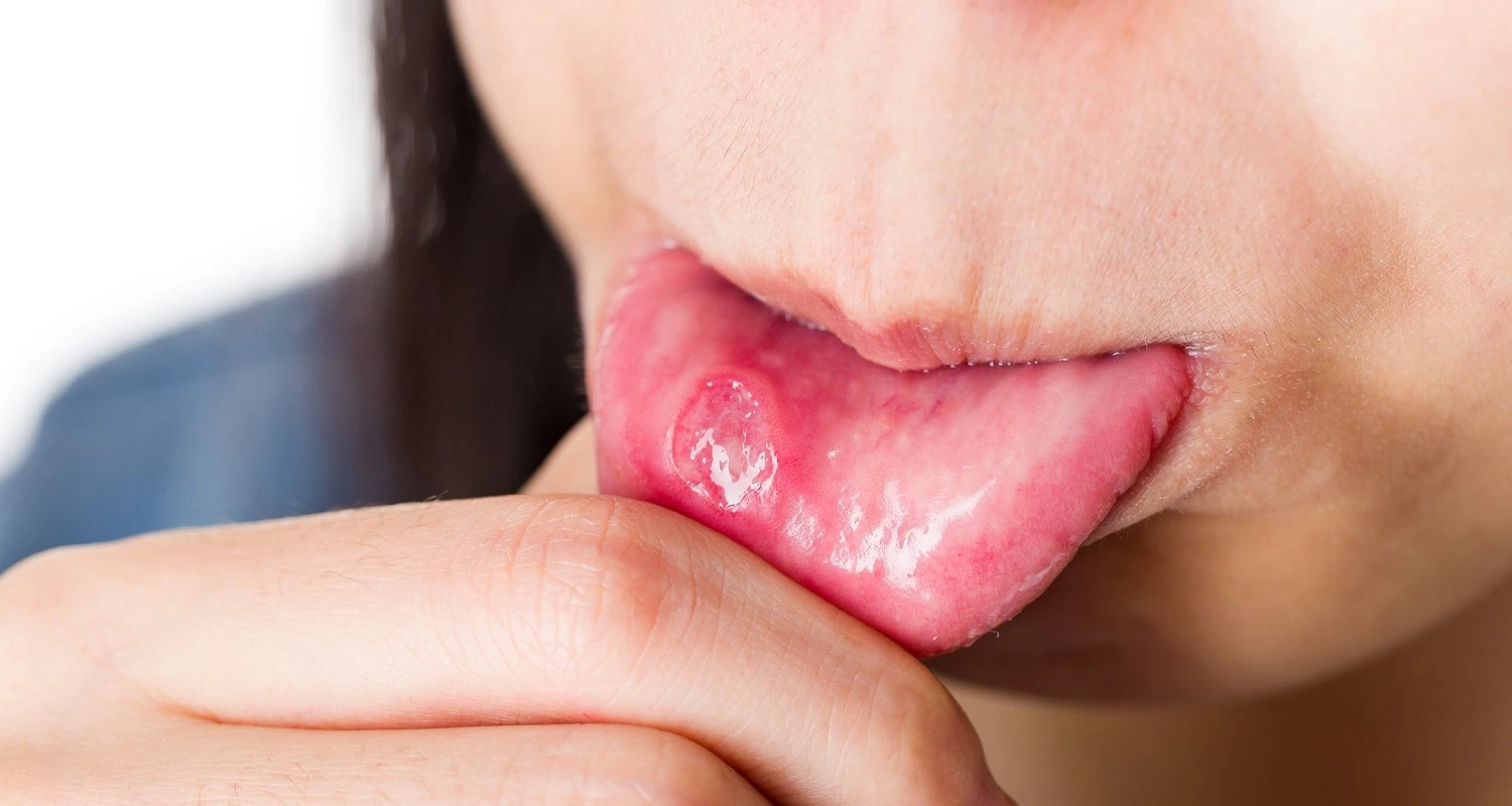 mouth ulcer vs. canker sore
