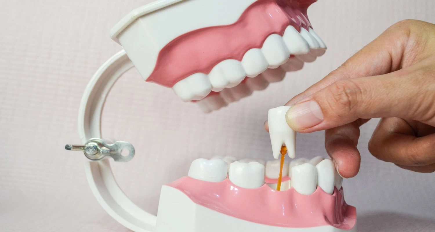 Proceso de curación de la extracción dental: 10 consejos para una recuperación rápida 
