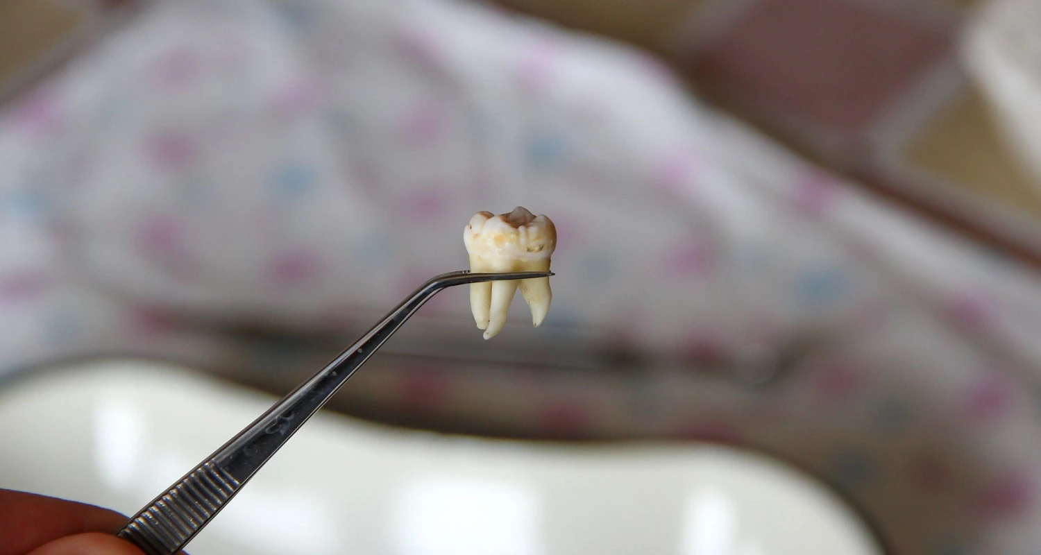 tooth extraction healing process