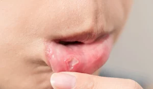 mouth ulcer vs. canker sore