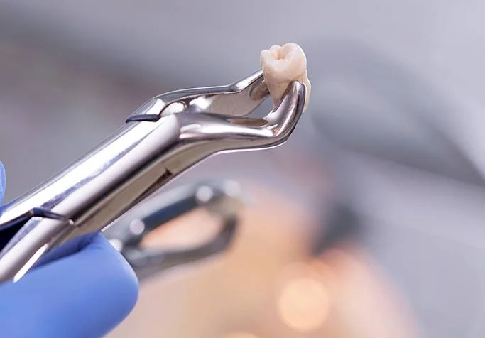 tooth extractions