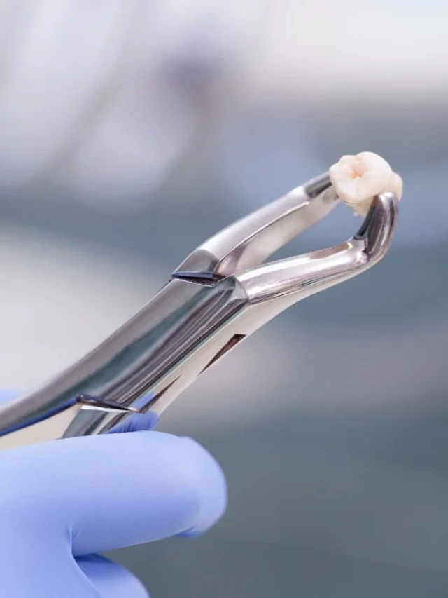 tooth extraction