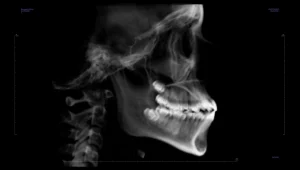 Cirugía de Cáncer Oral
