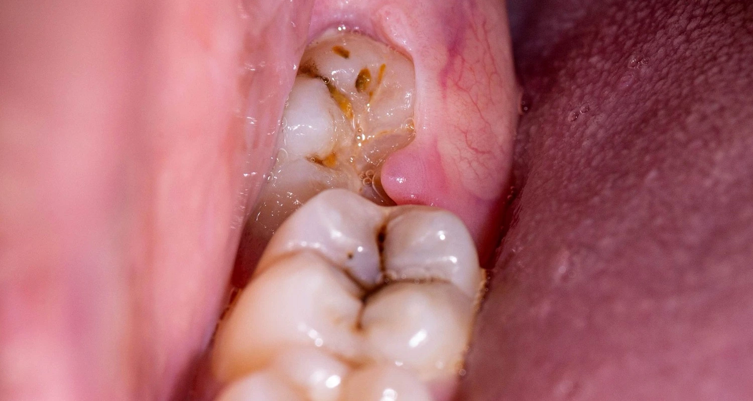 inflammation of the gum tissue around your wisdom teeth