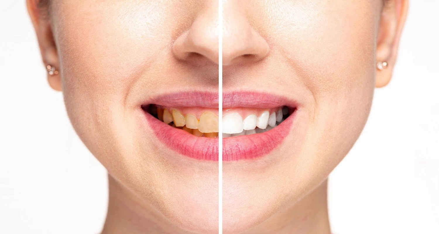 is it safe to whiten teeth