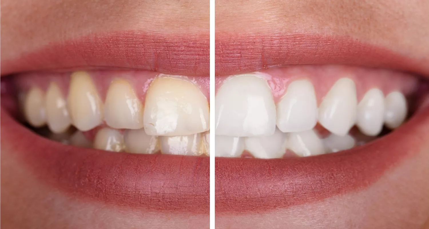 ¿Es segura la pasta dental con carbón activo? 5 consecuencias 9 whiten teeth