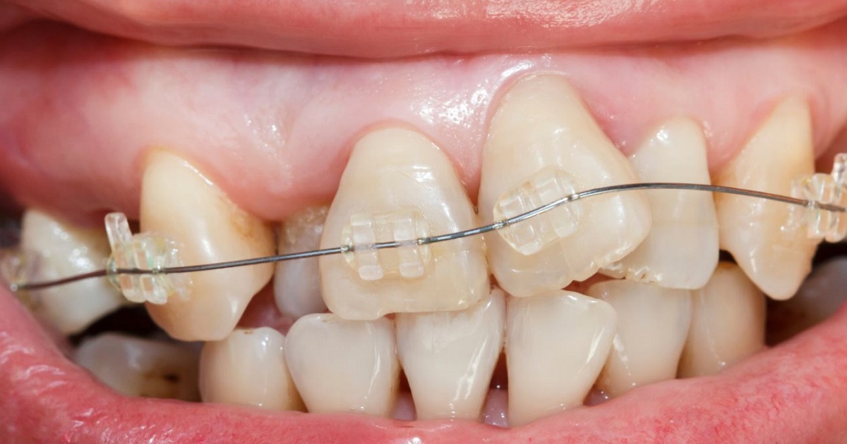 Dientes Delanteros Torcidos: 5 Causas Y Tratamientos