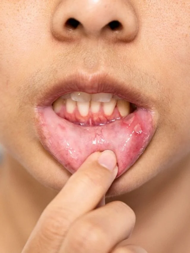 cropped-canker-sores.jpg