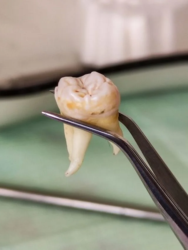 extracted wisdom tooth