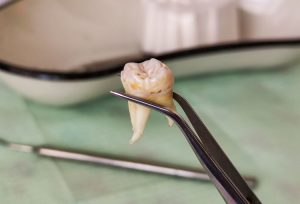 extracted wisdom tooth