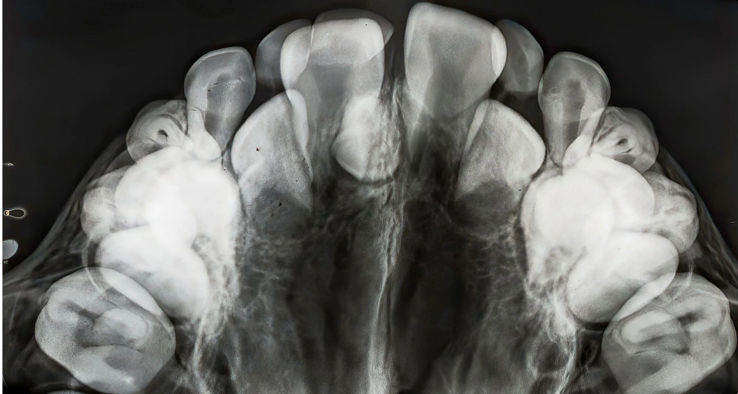 x-ray of hyperdontia