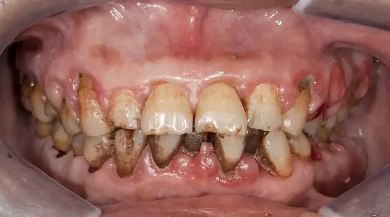 Enfermedades de los dientes