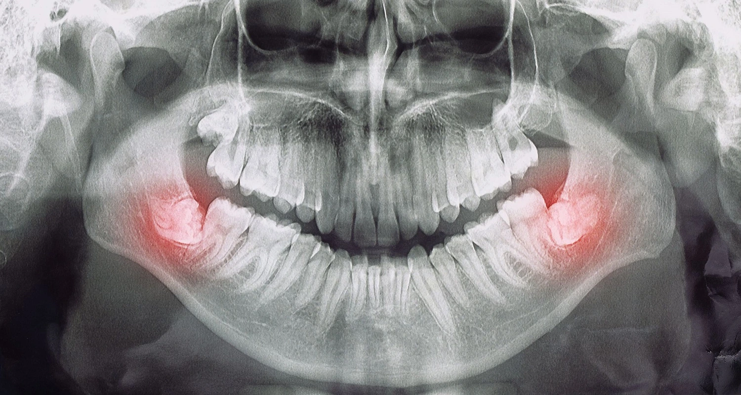 wisdom teeth radiograph