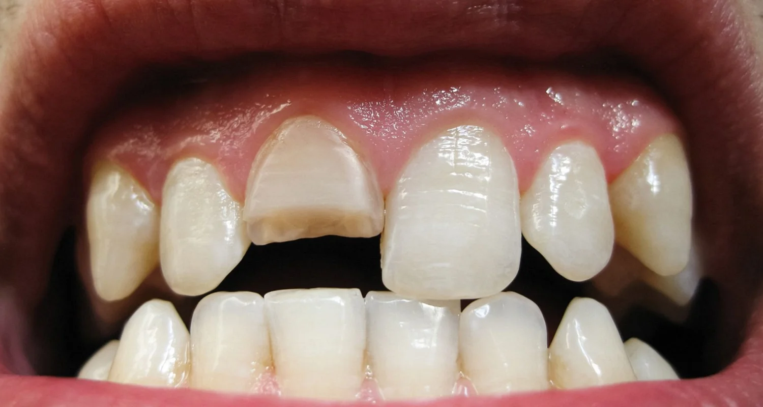 chipped front tooth repair 