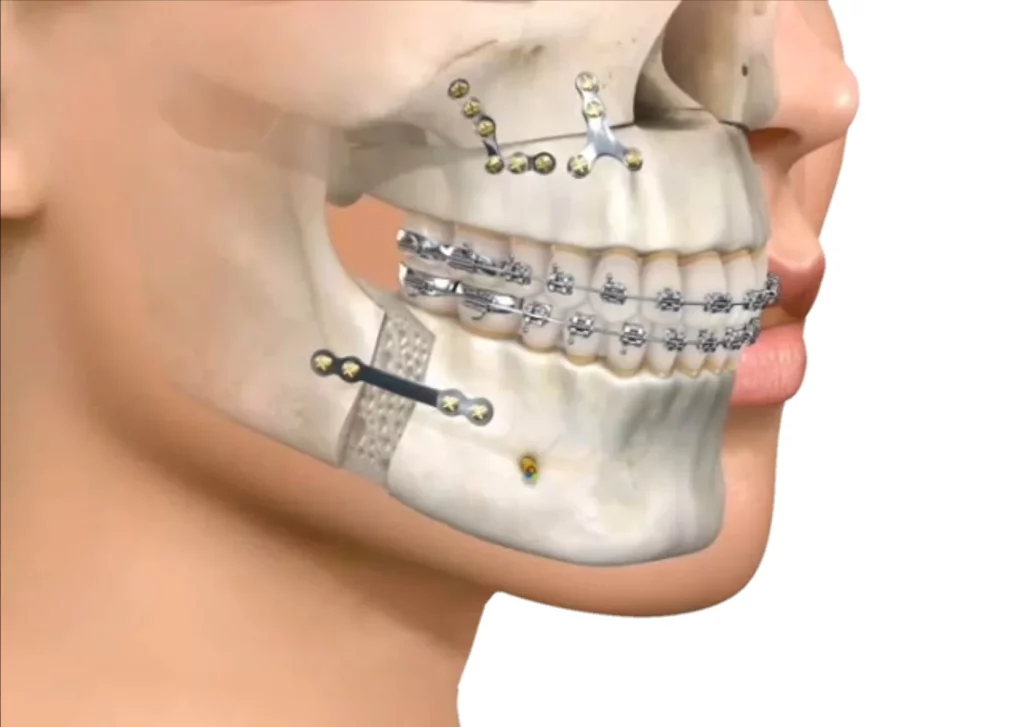 Cirugía Maxilofacial