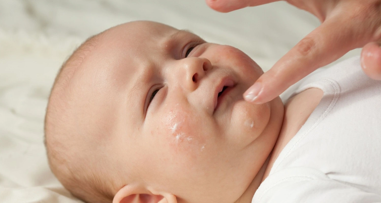 applying cream to the baby