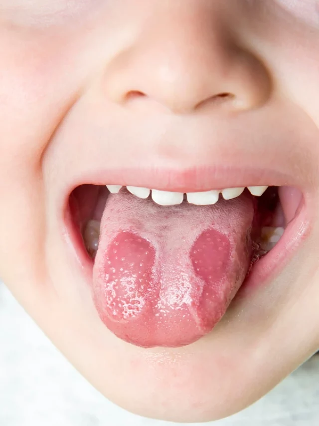 geographic tongue