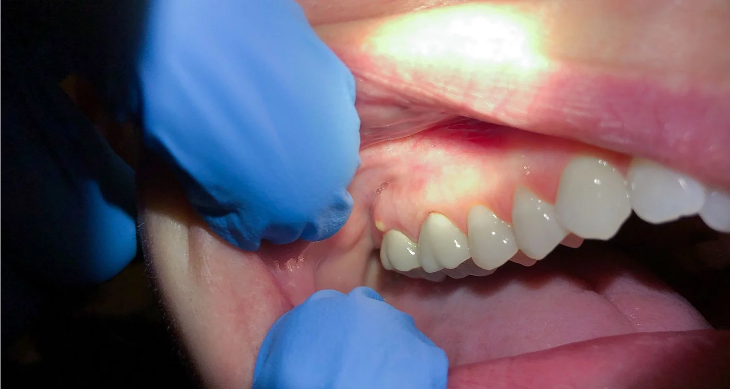 symptoms of tooth infection spreading to body