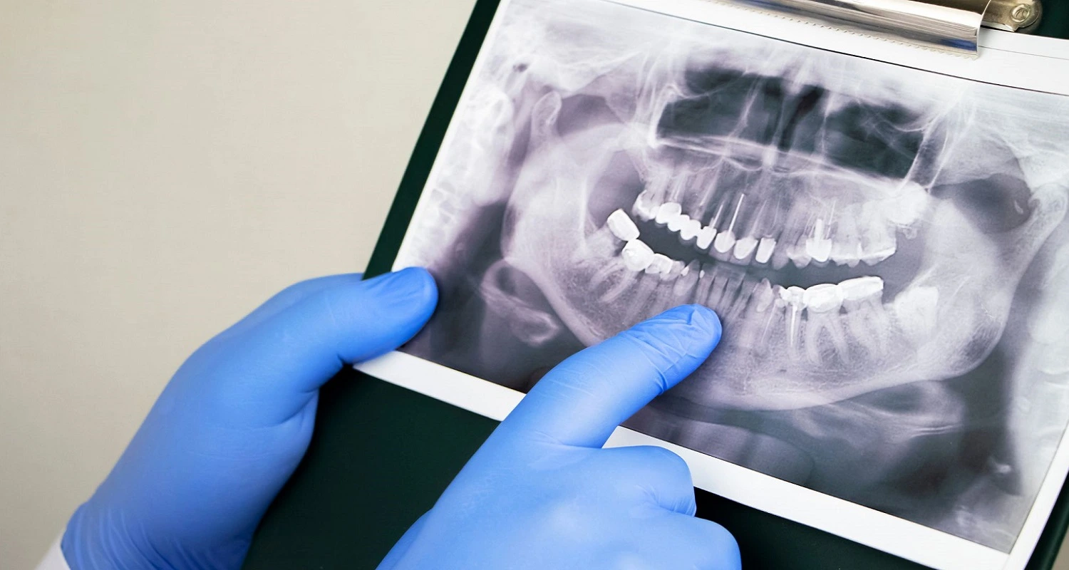 management of tooth dislocation