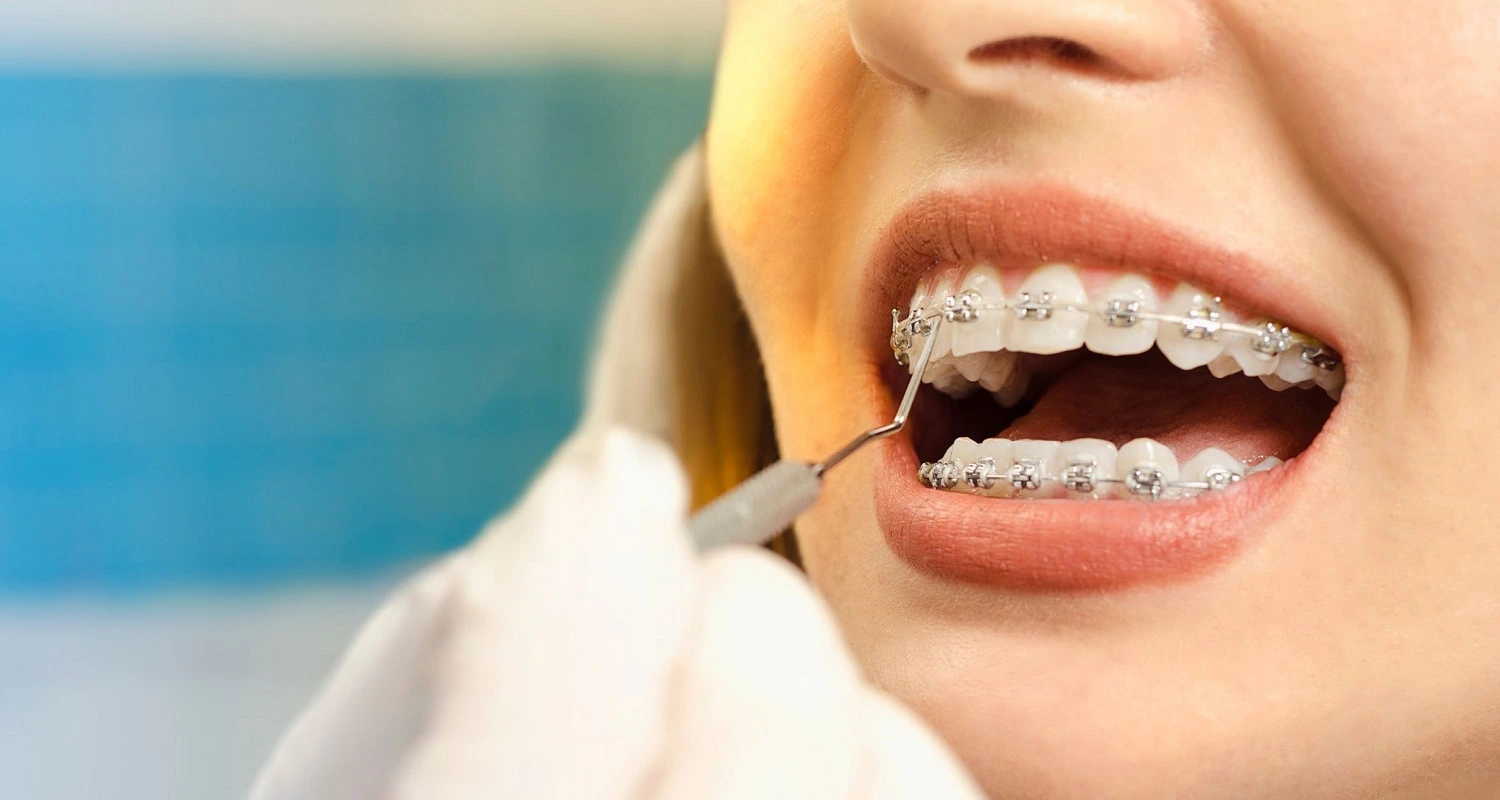 dentist placing braces