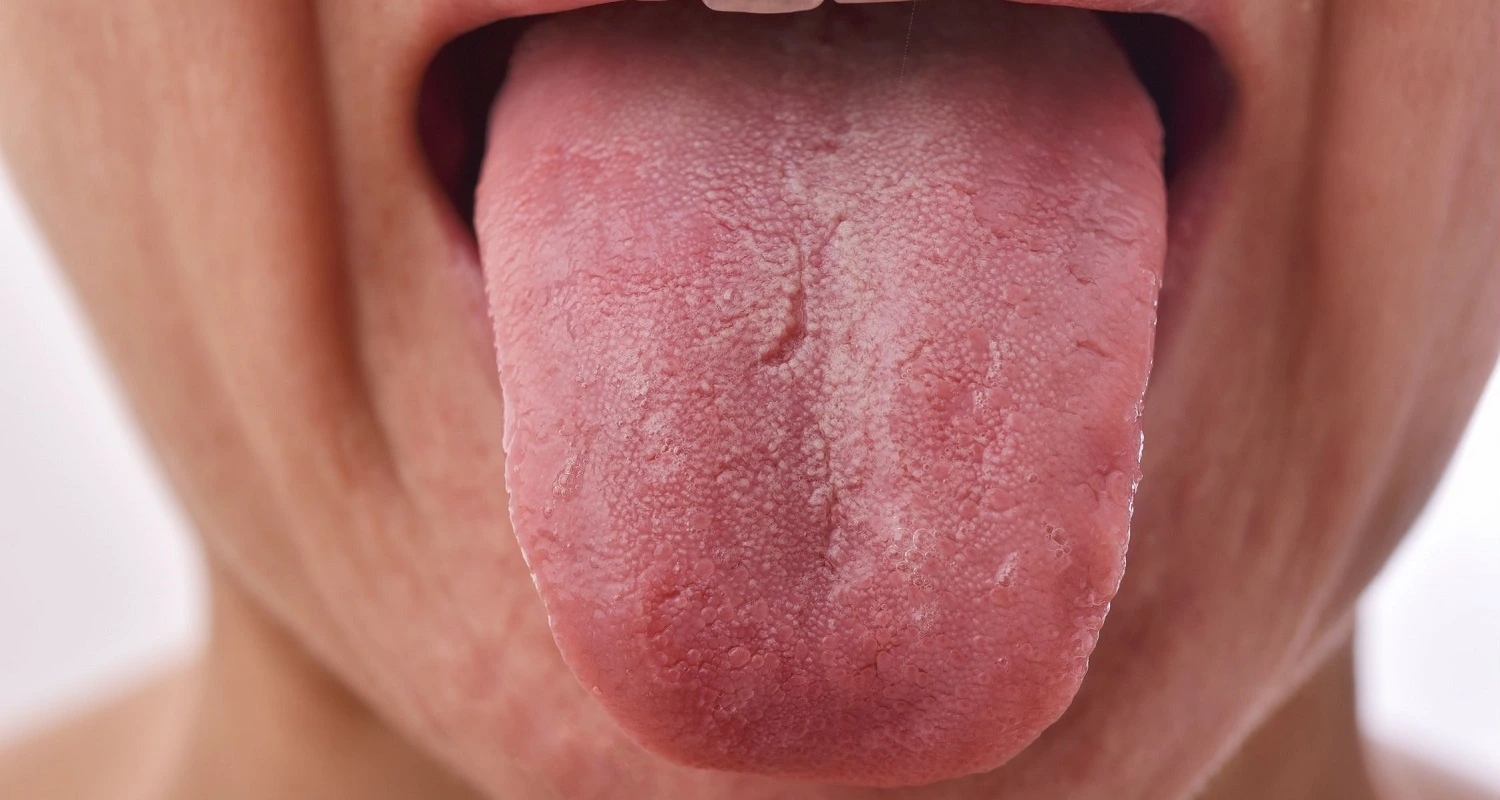 fissured white tongue