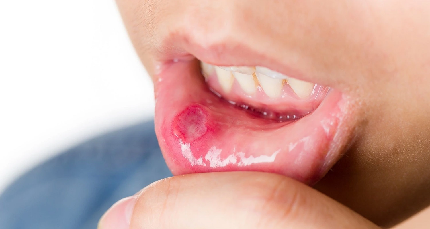 lesions in the mouth